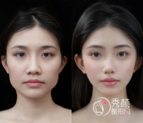 上海下颌角整形哪家好？