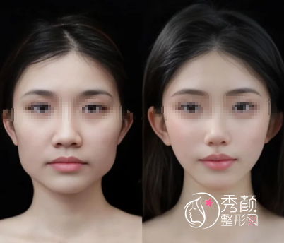 上海下颌角整形哪家好？九院、新华医院、伊莱美、时光…实力雄厚！