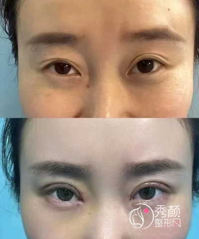 重庆双眼皮修复专家排名：周璐珩、杨琉舒、梁海彬、唐建奇…实力上榜