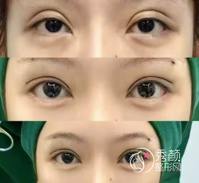 天津双眼皮修复好的医生排名：王文迪、姚庆君、卜胜利、陈志雄…可谓是实力派