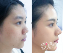 苏州玻尿酸注射隆鼻哪里