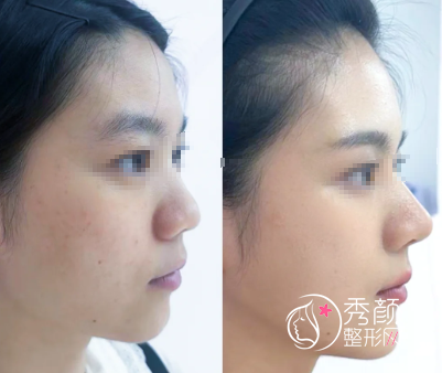 苏州玻尿酸注射隆鼻哪里效果好？苏大附二院、市立医院、康美…技术成熟