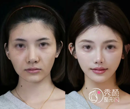 武汉玻尿酸注射医生排名：江迪、胡文亚、张琦、张岚…名气大、技术好