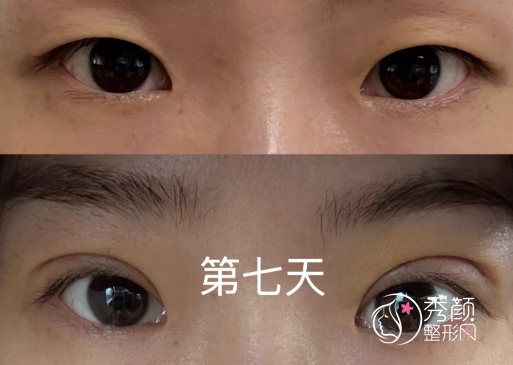 上海哪个医院割双眼皮技术好？东方医院、长征医院、上海九院…附人气专家