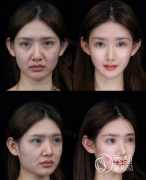 长春玻尿酸注射去哪里好