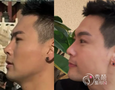 广州再生材料注射填充哪家好？优选热门的三家美容医院，公立、私立均有