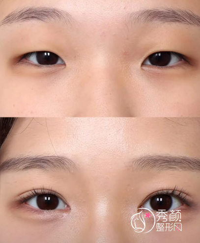 苏州双眼皮整形医院排名：苏大一附院、康美、美贝尔…高口碑认证