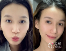 无锡填充玻尿酸哪家好？口碑整形医院测评，个个实力强