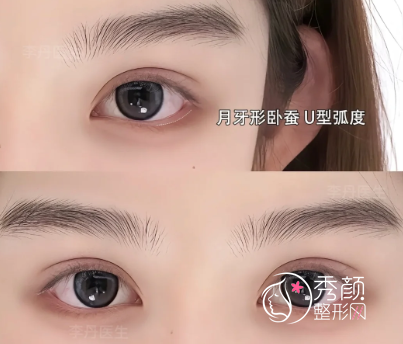 佛山双眼皮整形哪家好？公立、私立整形医院排行榜名单更新