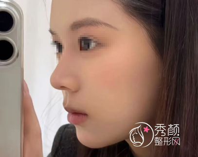 济南隆鼻医生推荐：张健、赵东红、汪帅、王召东…鼻整形技术各有优势