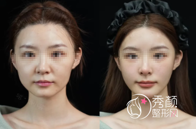 温州玻尿酸注射哪里比较好？市中西医结合医院、瑞安瑞丽、艺星…优势多