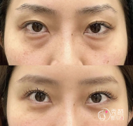 深圳去眼袋的正规医院排