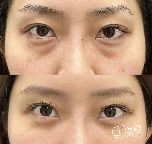 深圳去眼袋的正规医院排行榜，公立三甲医院领衔，民营医院跟随