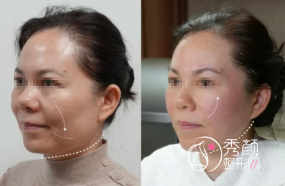 西安面部提升哪家医院做的好？排行榜前五名均是高分机构