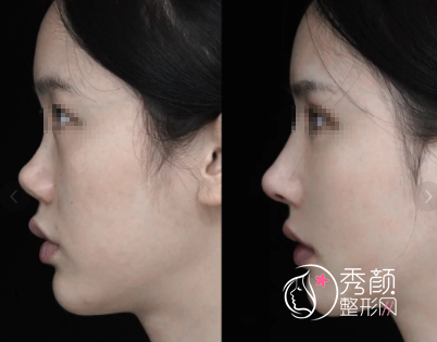 青岛假体隆鼻医院排名：市中心医院、壹美、博士、华颜美…口碑出众