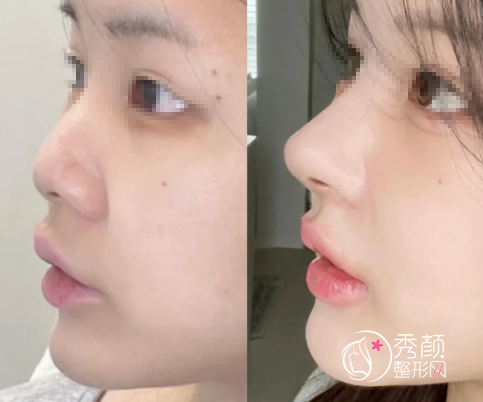 佛山玻尿酸注射隆鼻哪里效果好？内含实力整形医院&口碑专家