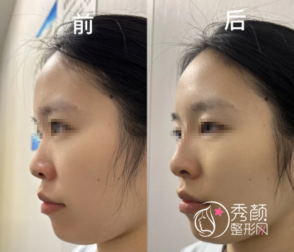 重庆隆鼻好的医生排名：薛斌、陈亮、单磊、刘林奇…专业度高