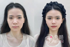 西安注射微调大佬名单：