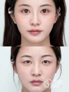 西安双眼皮手术医生推荐