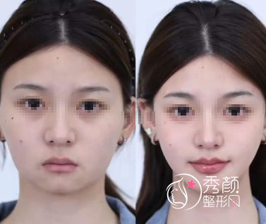 上海幼态注射哪位医生技术强？李花停、张炜、郭敬松、黄晔文等口碑好