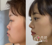 北京隆鼻三甲公立医院排