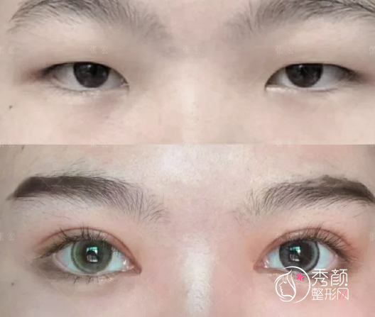 苏州做双眼皮比较好的医生有哪些？张治华、于文渊、端木雪峰、尹飞…特色显著