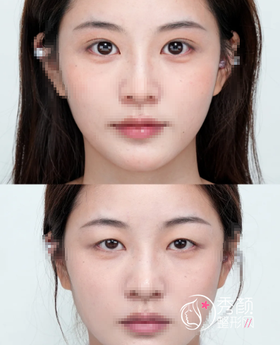 北京双眼皮整形美容医院排名，中日友好医院、画美等五家医院，术后反馈满分