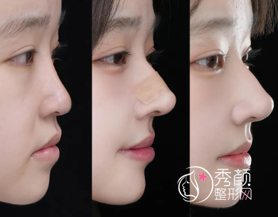 杭州假体隆鼻医院哪家好？浙大一院、浙大二院、艺星、美莱…均有实力专家服务