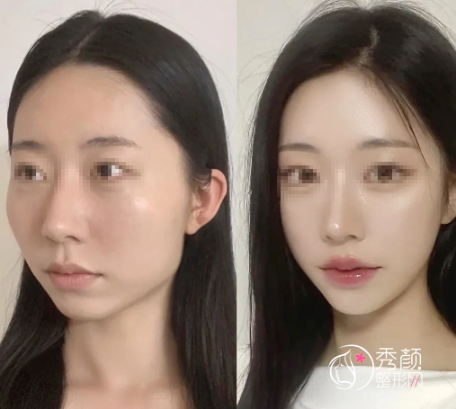 北京磨骨好的医院排名：协和医院、中日友好医院、北医三院…人气很旺