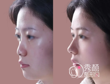 长沙隆鼻比较出名的医院有哪些？湘雅二院、省人民医院、雅美、亚韩…口碑好