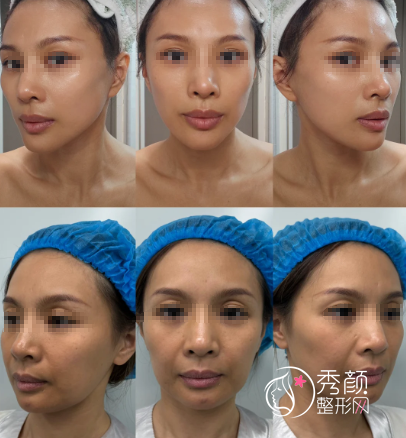 上海做大拉皮好的医生排行榜：亓发芝、陈红梅、吴建明、倪峰…颇受好评