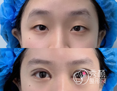 北京割双眼皮的医院哪家好？北京协和、韶华、华韩、叶子…公立私立均有