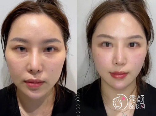 贵阳微整医院哪家好？盘点玻尿酸填充技术好的实力整形医院名单