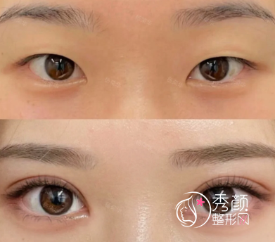 苏州割双眼皮好的医生有哪些？张治华、于文渊、李景方、陈卫堂…人气旺