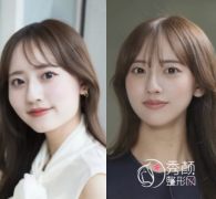 南京可以做颧骨手术的医