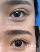 北京双眼皮修复专家名单