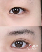 天津全切双眼皮哪家好？市一中心医院、市中西医结合医院、维美、美莱…很出