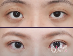 温州哪家医院割双眼皮比