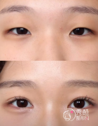 温州割双眼皮手术医院排名：市中西医结合医院、市人民医院、艺星…实力领先