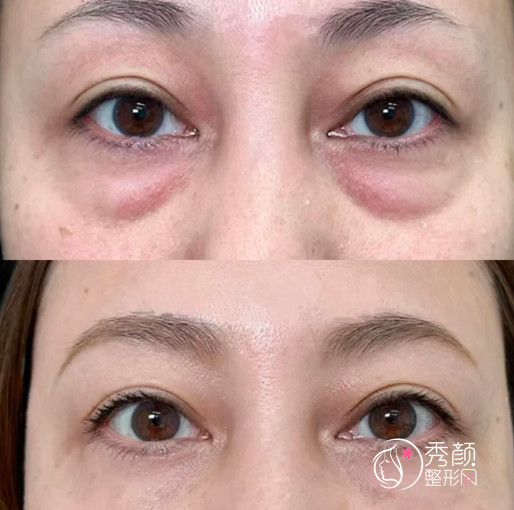 温州去眼袋哪家医院好？当地热门的公立VS私立整形医院盘点