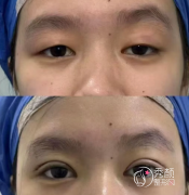 沈阳做双眼皮好的医生排名：袁继龙、金石峰、刘海滨、郭云莉…