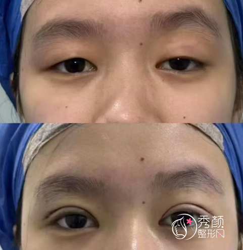 沈阳做双眼皮好的医生排名：袁继龙、金石峰、刘海滨、郭云莉…