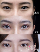 郑州做双眼皮哪家医院专