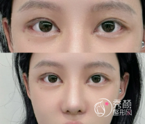 成都双眼皮修复厉害的医