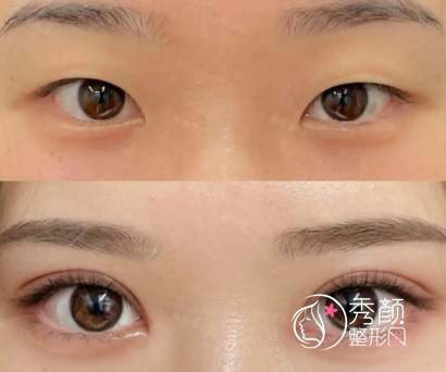 深圳双眼皮医生排行榜：李天石、刘月更、段春巍、肖峰…实力出众