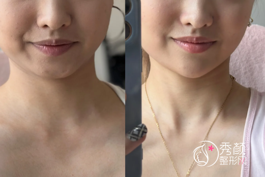 郑州哪个医院注射垫下巴好？盘点热门的微整注射整形机构名单