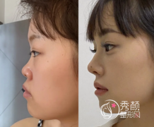 哈尔滨鼻子整形哪里好？