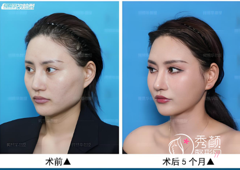 何照华做下颌角怎么样？技术点评、医生简介、坐诊机构一览