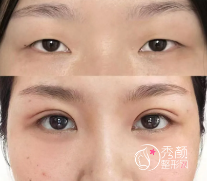 重庆做双眼皮专家排名榜：张恒术、樊东力、王文平…术后审美风格独特、辨识度高