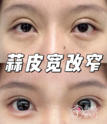 广州双眼皮修复医生排名：冯传波、赵成立、陈建武、郝健…好评度高